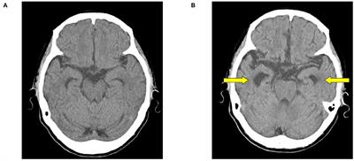 Successful Combination Therapy of Trazodone and Fluvoxamine for Pica in Alzheimer's Disease: A Case Report